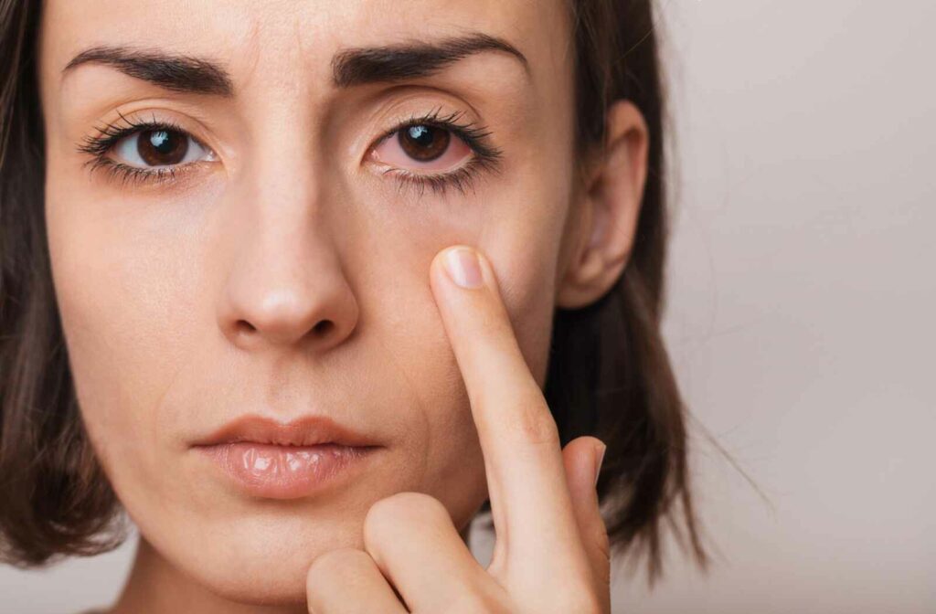 a women who has dry eye syndrome putting her finger to show her eye