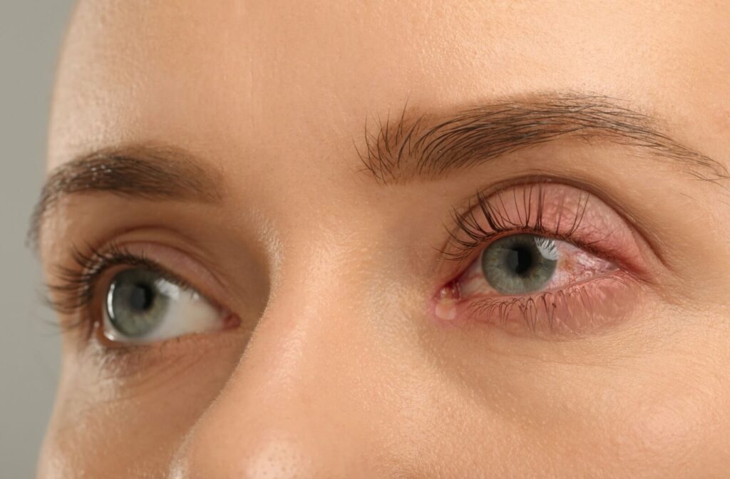A person's left eye appears watery, red, and irritated while the other remains unaffected.